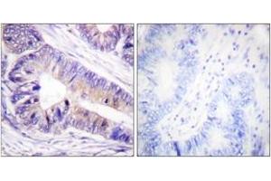 Immunohistochemistry analysis of paraffin-embedded human colon carcinoma tissue, using 14-3-3 zeta/delta (Ab-232) Antibody. (14-3-3 zeta 抗体  (AA 196-245))