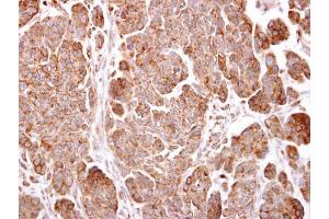 IHC-P Image TMEM59 antibody detects TMEM59 protein at cytosol on human ovarian carcinoma by immunohistochemical analysis. (TMEM59 抗体)