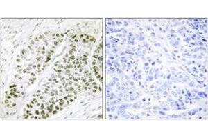 Immunohistochemistry analysis of paraffin-embedded human lung carcinoma, using ATF2 (Phospho-Ser480) Antibody. (ATF2 抗体  (pSer480))