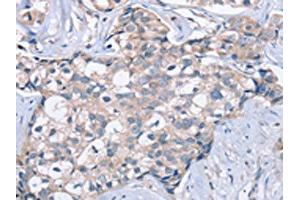 The image on the left is immunohistochemistry of paraffin-embedded Human breast cancer tissue using ABIN7129969(KCNQ5 Antibody) at dilution 1/60, on the right is treated with fusion protein. (KCNQ5 抗体)