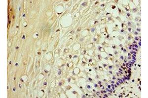 Immunohistochemistry of paraffin-embedded human cervical cancer using ABIN7142902 at dilution of 1:100 (AKAP1 抗体  (AA 413-662))