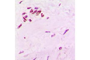 Immunohistochemical analysis of SOX6 staining in human lung cancer formalin fixed paraffin embedded tissue section. (SOX6 抗体  (N-Term))