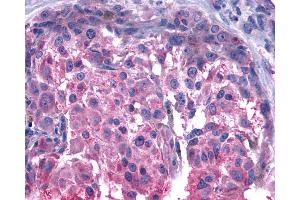 Anti-BOB / GPR15 antibody IHC of human Skin, Melanoma. (GPR15 抗体  (C-Term))