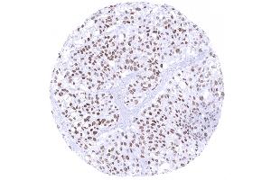 Urinary bladder Muscle invasive urothelial carcinoma with moderate to strong GATA3 immunostaining of tumor cells (GATA3 抗体)