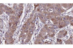 ABIN6276678 at 1/100 staining Human liver cancer tissue by IHC-P. (CA2 抗体  (C-Term))
