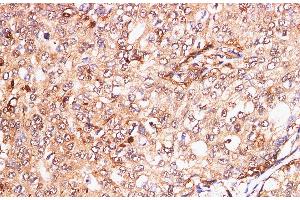 Immunohistochemistry of paraffin-embedded Human breast cancer using S100A11 Polyclonal Antibody at dilution of 1:200 (S100A11 抗体)