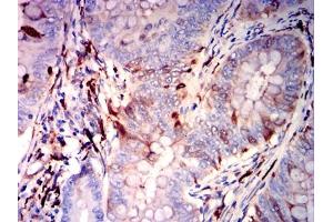 Immunohistochemical analysis of paraffin-embedded rectal cancer tissues using GSN mouse mAb with DAB staining. (Gelsolin 抗体)