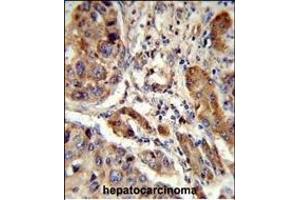 Formalin-fixed and paraffin-embedded human hepatocarcinoma reacted with EBP Antibody (N-term), which was peroxidase-conjugated to the secondary antibody, followed by DAB staining. (EBP 抗体  (N-Term))