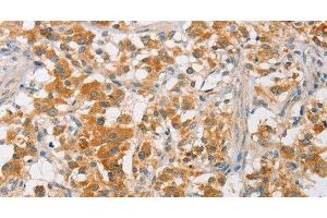 Immunohistochemistry of paraffin-embedded Human thyroid cancer using ARMCX3 Polyclonal Antibody at dilution of 1:40 (ARMCX3 抗体)