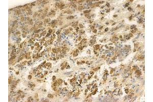 ABIN6256349 and ABIN6267599 at 1/100 staining human melanoma by IHC-P. (NF-kB p65 抗体  (pSer468))