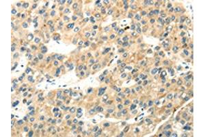 The image on the left is immunohistochemistry of paraffin-embedded Human liver cancer tissue using ABIN7193040(WDR36 Antibody) at dilution 1/35, on the right is treated with synthetic peptide. (WDR36 抗体)