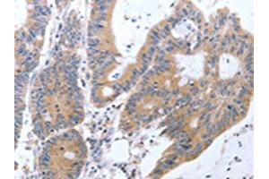 The image on the left is immunohistochemistry of paraffin-embedded Human colon cancer tissue using ABIN7131299(TAT Antibody) at dilution 1/35, on the right is treated with fusion protein. (Tat 抗体)
