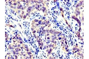 IHC image of ABIN7158430 diluted at 1:300 and staining in paraffin-embedded human pancreatic cancer performed on a Leica BondTM system. (LPP 抗体  (AA 227-391))