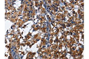 The image on the left is immunohistochemistry of paraffin-embedded Human thyroid cancer tissue using ABIN7130029(KLRB1 Antibody) at dilution 1/40, on the right is treated with fusion protein. (CD161 抗体)