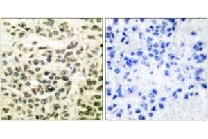 Immunohistochemistry analysis of paraffin-embedded human breast carcinoma tissue, using GSK3 alpha/beta (Ab-279/216) Antibody. (GSK3 alpha/beta 抗体  (AA 246-295))
