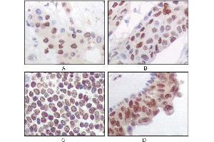 Immunohistochemical analysis of paraffin-embedded human liver carcinoma (A), esophagus carcinoma (B), normal spleen tissue(C), breast carcinoma (D), showing nuclear and cytoplasmic localization using PRAK mouse mAb with DAB staining. (MAPKAP Kinase 5 抗体)