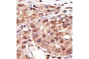 Formalin-fixed and paraffin-embedded human cancer tissue reacted with the primary antibody, which was peroxidase-conjugated to the secondary antibody, followed by AEC staining. (MTM1 抗体  (N-Term))