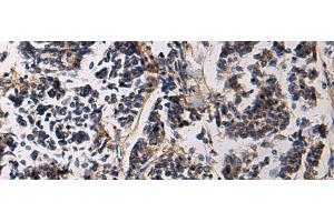 Immunohistochemistry of paraffin-embedded Human breast cancer tissue using SSH3 Polyclonal Antibody at dilution of 1:60(x200) (SSH3 抗体)