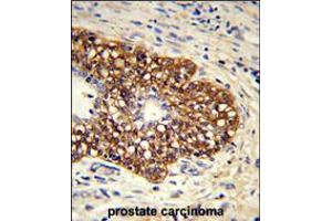 Formalin-fixed and paraffin-embedded human prostate carcinoma reacted with CYP8A1 Antibody , which was peroxidase-conjugated to the secondary antibody, followed by DAB staining. (PTGIS 抗体  (C-Term))