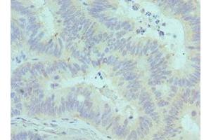 Immunohistochemistry of paraffin-embedded human colon cancer using ABIN7147246 at dilution of 1:100 (CADM1 抗体  (AA 45-344))