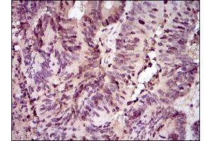 Immunohistochemical analysis of paraffin-embedded colon cancer tissues using PCNA mouse mAb with DAB staining. (PCNA 抗体  (AA 53-196))