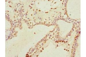 Immunohistochemistry of paraffin-embedded human breast cancer using ABIN7172156 at dilution of 1:100 (THRSP 抗体  (AA 1-146))