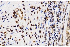 Immunohistochemistry of paraffin-embedded Human rectal cancer using Asymmetric DiMethyl-Histone H4-R3 Polyclonal Antibody at dilution of 1:200 (40x lens).