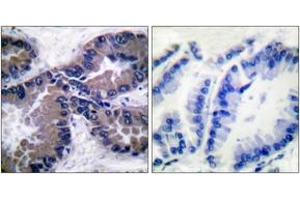 Immunohistochemistry analysis of paraffin-embedded human lung carcinoma tissue, using Nrf2 Antibody. (NRF2 抗体  (AA 556-605))