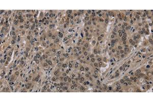 Immunohistochemistry of paraffin-embedded Human liver cancer using HIST1H2AH Polyclonal Antibody at dilution of 1:40 (HIST1H2AH 抗体)