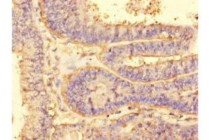 Immunohistochemistry of paraffin-embedded human endometrial cancer using ABIN7143770 at dilution of 1:100 (ALG2 抗体  (AA 303-405))