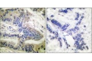 Immunohistochemistry analysis of paraffin-embedded human colon carcinoma, using Caspase 6 (Phospho-Ser257) Antibody. (Caspase 6 抗体  (pSer257))