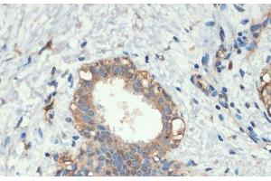 Immunohistochemistry of paraffin-embedded Human breast cancer using Smad5 Polyclonal Antibody at dilution of 1:200 (40x lens). (SMAD5 抗体)