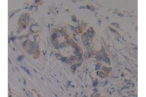 Detection of F1+2 in Human Pancreatic cancer Tissue using Polyclonal Antibody to Prothrombin Fragment 1+2 (F1+2) (Prothrombin Fragment 1+2 抗体)
