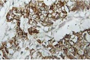 Immunohistochemistry (IHC) analyzes of HLA-DOalpha antibody in paraffin-embedded human breast carcinoma tissue. (HLA-DOA 抗体)