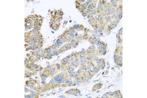 Immunohistochemistry of paraffin-embedded human liver cancer using SYT4 antibody at dilution of 1:100 (x40 lens). (SYT4 抗体)