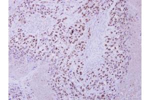 IHC-P Image Immunohistochemical analysis of paraffin-embedded H661 xenograft, using ZNF217 antibody [N3C2], Internal, antibody at 1:250 dilution. (ZNF217 抗体)