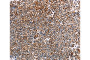 Immunohistochemistry of Human liver cancer using PLXNA2 Polyclonal Antibody at dilution of 1:40 (Plexin A2 抗体)