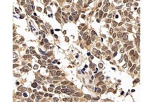 Immunohistochemistry analysis of paraffin-embedded human lung cancer using p27 Polyclonal Antibody at dilution of 1:200. (P27 抗体)