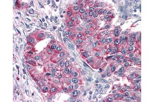 Anti-T1R3 / TAS1R3 antibody IHC of human Lung, Non-Small Cell Carcinoma. (TAS1R3 抗体  (N-Term))