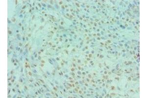 Immunohistochemistry of paraffin-embedded human breast cancer using ABIN7150791 at dilution of 1:100 (DYRK2 抗体  (AA 502-601))