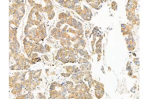 ABIN7094587 and ABIN7098636 at 1/100 staining Human breast cancer by IHC-P.