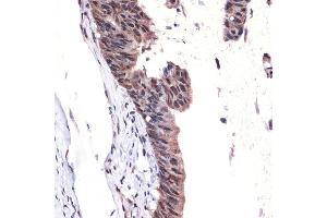 Immunohistochemistry of paraffin-embedded human colon carcinoma using MBD3 Rabbit mAb (ABIN7268492) at dilution of 1:100 (40x lens). (MBD3 抗体)