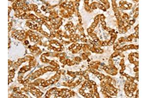 The image on the left is immunohistochemistry of paraffin-embedded Human thyroid cancer tissue using ABIN7130771(PTPN22 Antibody) at dilution 1/20, on the right is treated with fusion protein. (PTPN22 抗体)