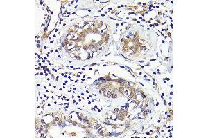 Immunohistochemistry of paraffin-embedded human breast cancer using IMPDH2 Rabbit pAb (ABIN7267853) at dilution of 1:100 (40x lens). (IMPDH2 抗体  (AA 215-514))