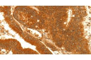 Immunohistochemistry of paraffin-embedded Human colon cancer using NAPA Polyclonal Antibody at dilution of 1:35 (NAPA 抗体)