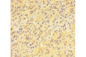 Immunohistochemistry of paraffin-embedded human glioma using ABIN7163391 at dilution of 1:100 (PAG1 抗体  (AA 97-432))
