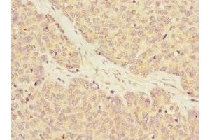 Immunohistochemistry of paraffin-embedded human ovarian cancer using ABIN7167152 at dilution of 1:100 (RASA4 抗体  (AA 60-290))