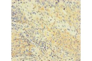 Immunohistochemistry of paraffin-embedded human cervical cancer using ABIN7174776 at dilution of 1:100 (C1orf112 抗体  (AA 301-530))