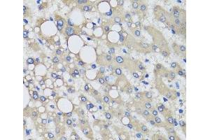 Immunohistochemistry of paraffin-embedded Human liver damage using PRODH Polyclonal Antibody at dilution of 1:100 (40x lens). (PRODH 抗体)