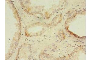 Immunohistochemistry of paraffin-embedded human prostate cancer using ABIN7176347 at dilution of 1:100 (ZNF501 抗体  (AA 6-305))